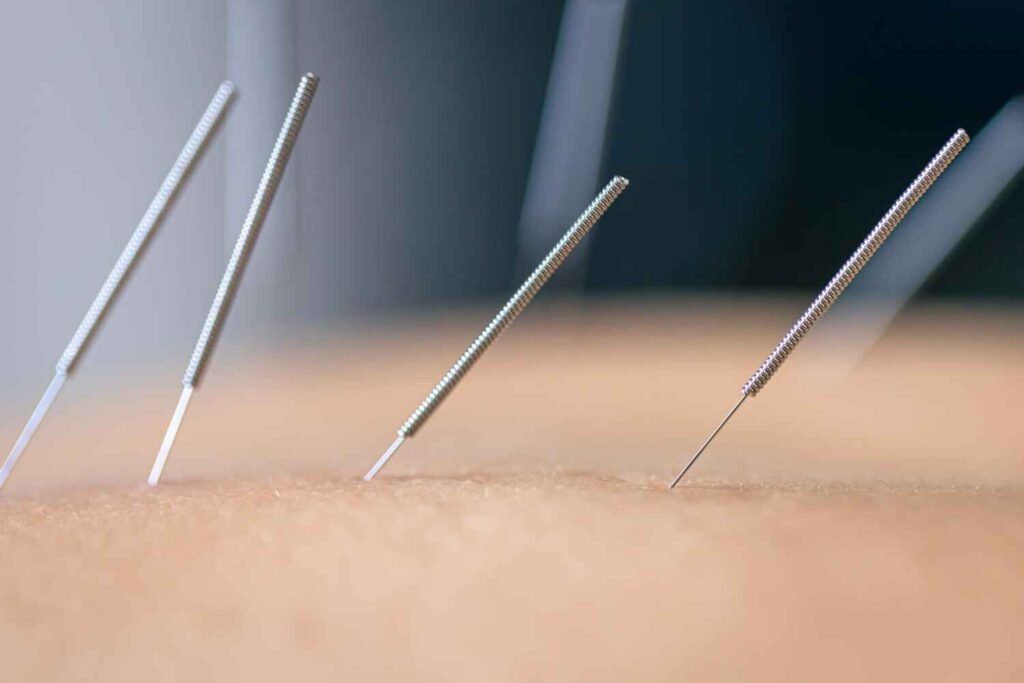 "A licensed acupuncturist placing thin needles on a patient's back for pain relief during an acupuncture session."